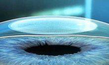 全飛秒雷射手術