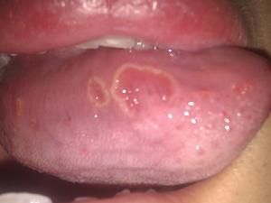 舌頭潰瘍