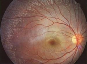 視網膜神經炎 視網膜神經炎