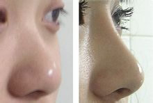 隆鼻手術