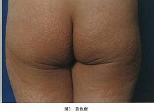 原發性高脂蛋白血症與黃瘤增生病