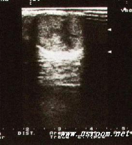 心包內惡性畸胎瘤