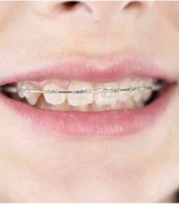 牙齒矯正 牙齒矯正