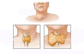 甲亢危象 甲亢危象