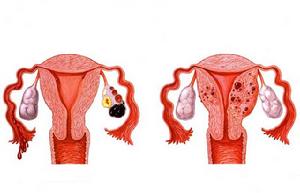 （圖）子宮內膜異位症