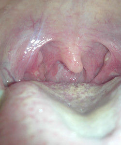 皰疹性咽峽炎 皰疹性咽峽炎