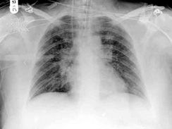 小兒腺病毒性肺炎 小兒腺病毒性肺炎