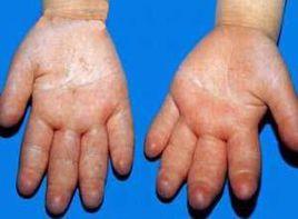 全身持續性水腫 全身持續性水腫