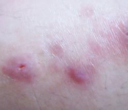 外陰滑膜肉瘤 外陰滑膜肉瘤