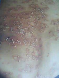 癬牛皮癬銀屑病 癬牛皮癬銀屑病