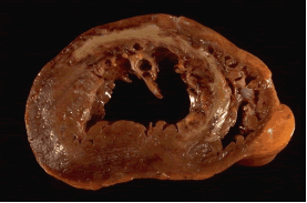 離心性肥大 離心性肥大