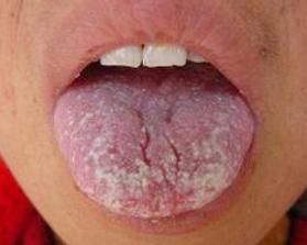 口腔念珠菌病 口腔念珠菌病