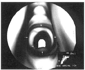 喉室脫垂 喉室脫垂