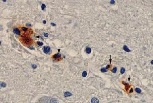 （圖）一落基山斑點熱致死病例的腦血管免疫組化分析結果。褐色區域為斑點熱群立克次體