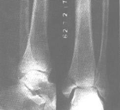 踝關節損傷 踝關節損傷