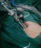 腹腔鏡膽囊切除術 腹腔鏡膽囊切除術
