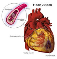 隱匿型冠狀動脈粥樣硬化性心臟病