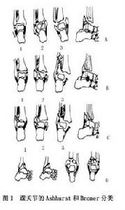 （圖）踝關節骨折