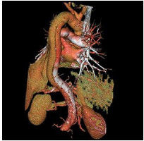主動脈夾層 主動脈夾層