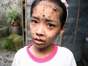 黑素細胞痣 黑素細胞痣