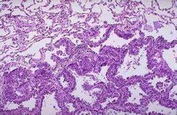 未分化癌 未分化癌