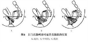 先天性肛門直腸畸形