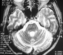Korsakoff綜合徵 Korsakoff綜合徵