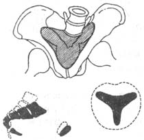 遠端腎小管性酸中毒