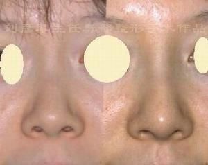 軟骨隆鼻 軟骨隆鼻