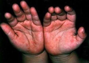 口足手病 口足手病