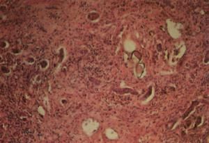 腦型血吸蟲病 腦型血吸蟲病