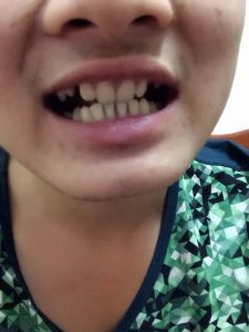 先天性缺牙 先天性缺牙