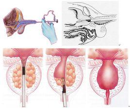 前列腺電切術 前列腺電切術