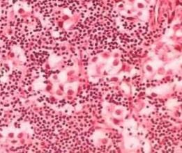 顱內生殖細胞瘤 顱內生殖細胞瘤