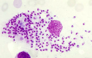 噬血細胞綜合徵