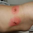 分段診刮 分段診刮