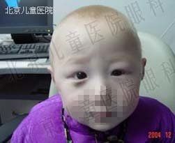 眼球震顫阻滯綜合徵 眼球震顫阻滯綜合徵