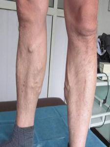 盆腔靜脈曲張 盆腔靜脈曲張