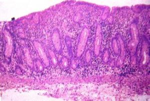 熱帶口炎性腹瀉 熱帶口炎性腹瀉
