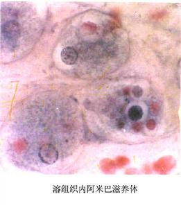 溶組織內阿米巴