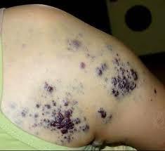 藍色橡皮大皰痣 藍色橡皮大皰痣