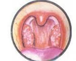 白血病性咽峽炎 白血病性咽峽炎