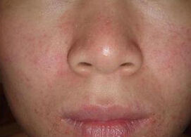 面部過敏性皮炎