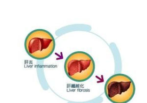 血吸蟲病 血吸蟲病