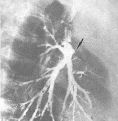 過敏性支氣管肺麴黴病