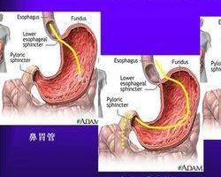 鼻空腸管 鼻空腸管