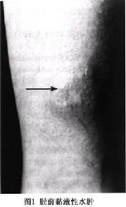 脛前黏液水腫 脛前黏液水腫