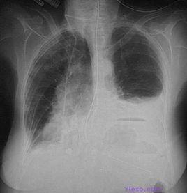 胸腔積水 胸腔積水