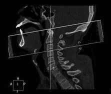頸髓損傷 頸髓損傷