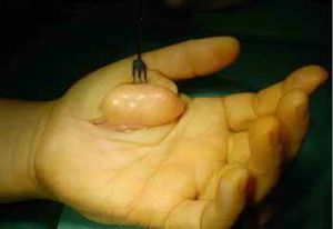 黃色素瘤 黃色素瘤